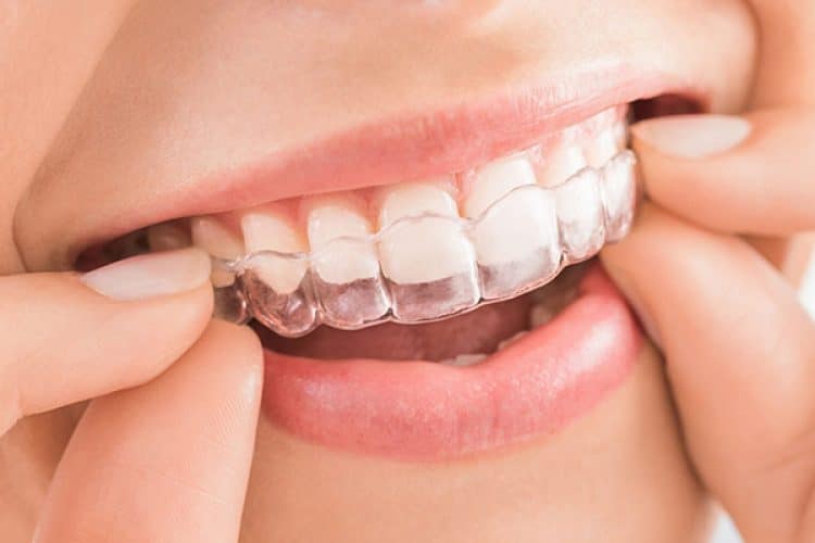 invisalign