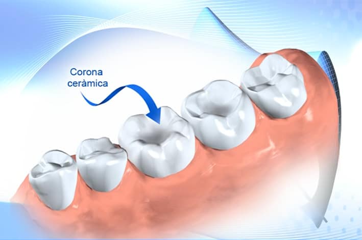 3.corona_ceramica3def