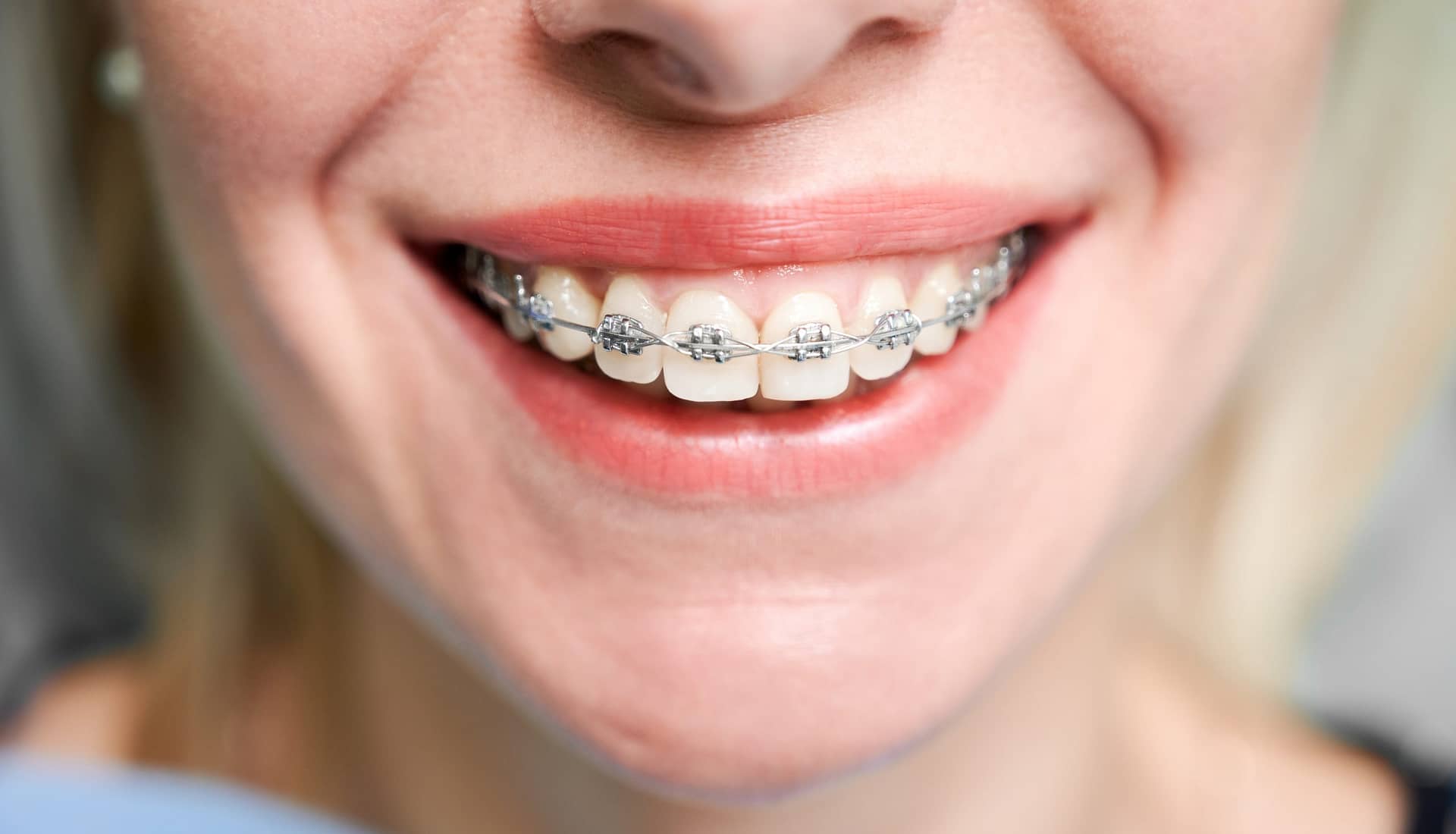 Close up of woman with charming smile demonstrating white teeth with orthodontic brackets. Female patient showing results of dental braces treatment. Concept of orthodontic treatment and dentistry.